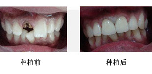 在郑州镶牙价格是多少