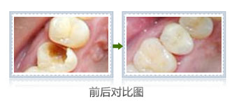 牙齿缺损严重可以补牙吗