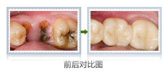 蛀牙可以补吗