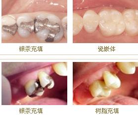 牙齿坏了补牙多少钱