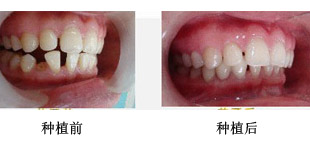 种植牙术后吃什么